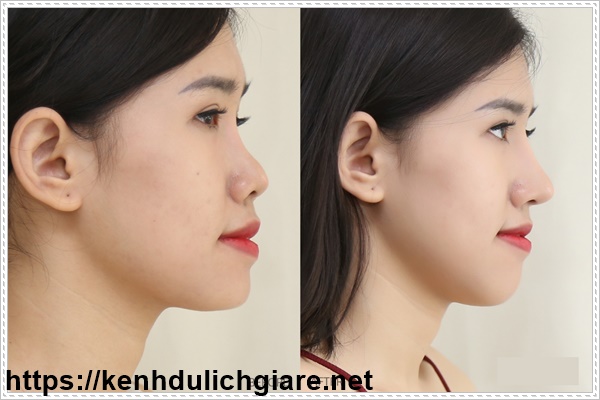 Sau khi n&acirc;ng mũi n&ecirc;n ki&ecirc;ng ăn bao l&acirc;u?