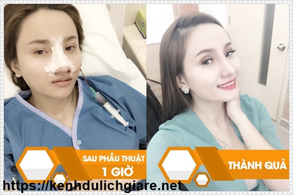 Độ bền nâng mũi được bao lâu?
