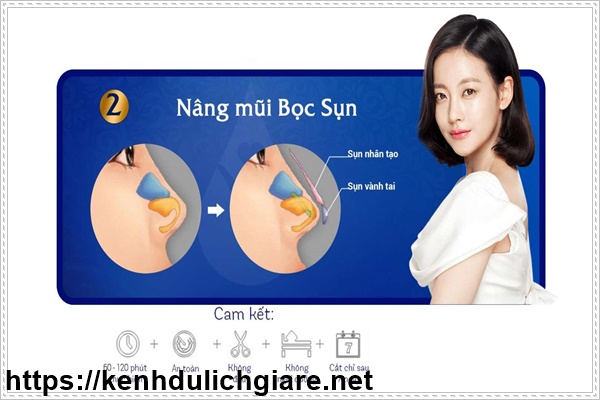 Độ bền nâng mũi bọc sụn được gần 10 năm