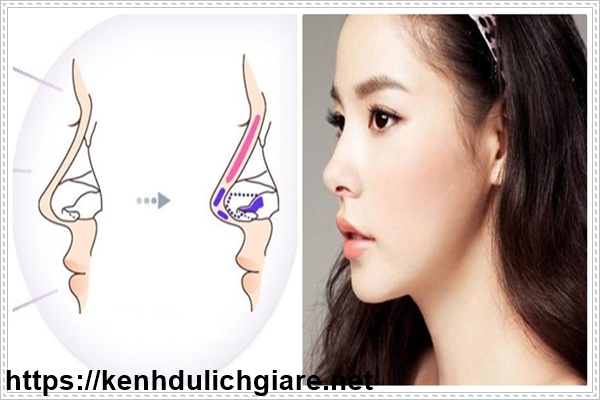 Sau khi phẫu thuật n&acirc;ng mũi ki&ecirc;ng ăn g&igrave;