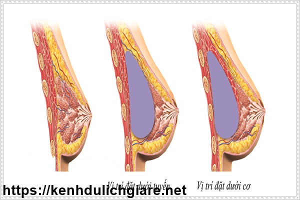 Phẫu thuật thẩm mỹ nâng ngực nội soi