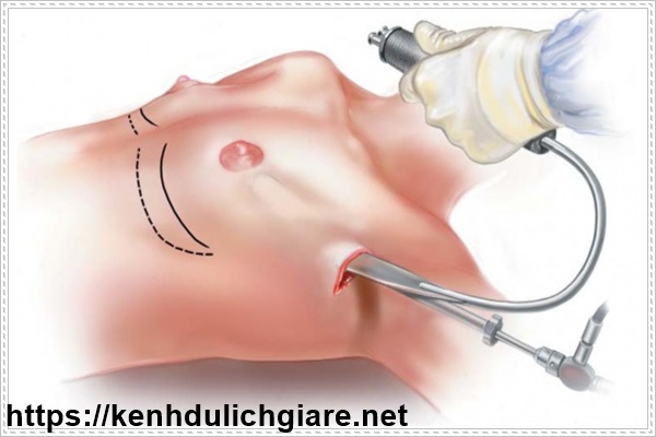 Nâng ngực nội soi đường nách