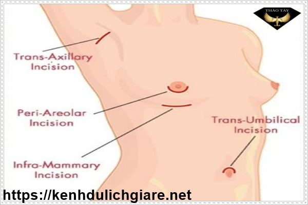 Các phương pháp nâng ngực nội soi